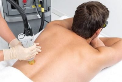 Laser-Hair-Removal-For-Men-640x334