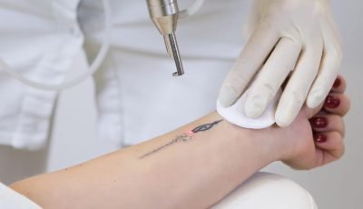 Laser-Tattoo-Removal-shutterstock_1234005517-scaled-1