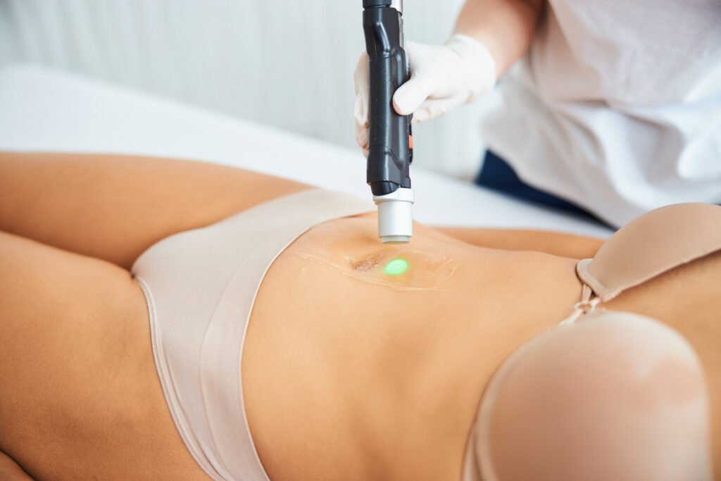 Spa client undergoing a belly hair removal procedure